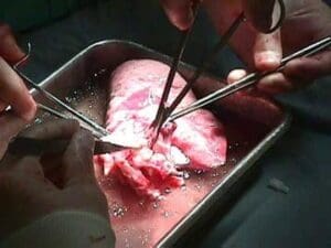 PRELEVARE DE ORGANE LA SPITALUL JUDETEAN TIMIS